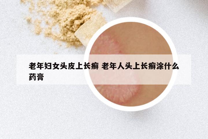 老年妇女头皮上长癣 老年人头上长癣涂什么药膏