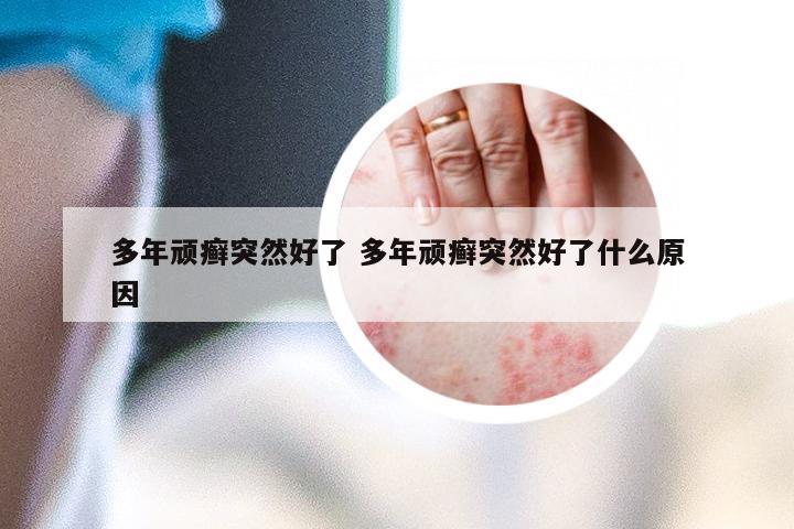 多年顽癣突然好了 多年顽癣突然好了什么原因
