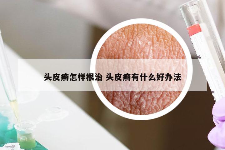 头皮癣怎样根治 头皮癣有什么好办法