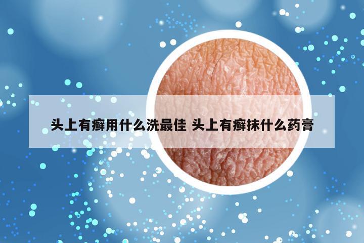 头上有癣用什么洗最佳 头上有癣抹什么药膏