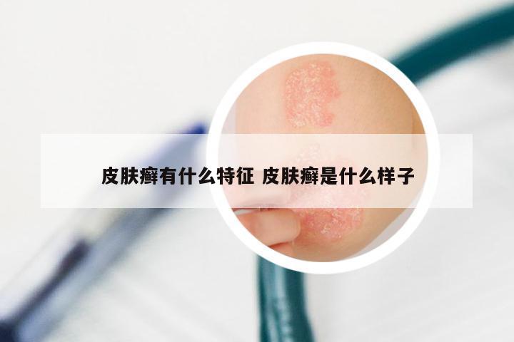 皮肤癣有什么特征 皮肤癣是什么样子