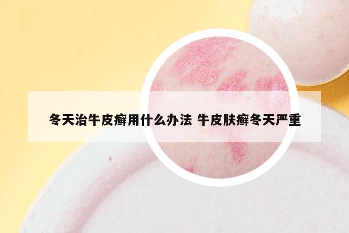 冬天治牛皮癣用什么办法 牛皮肤癣冬天严重