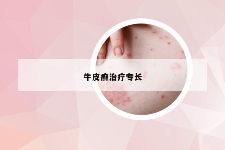 牛皮癣治疗专长