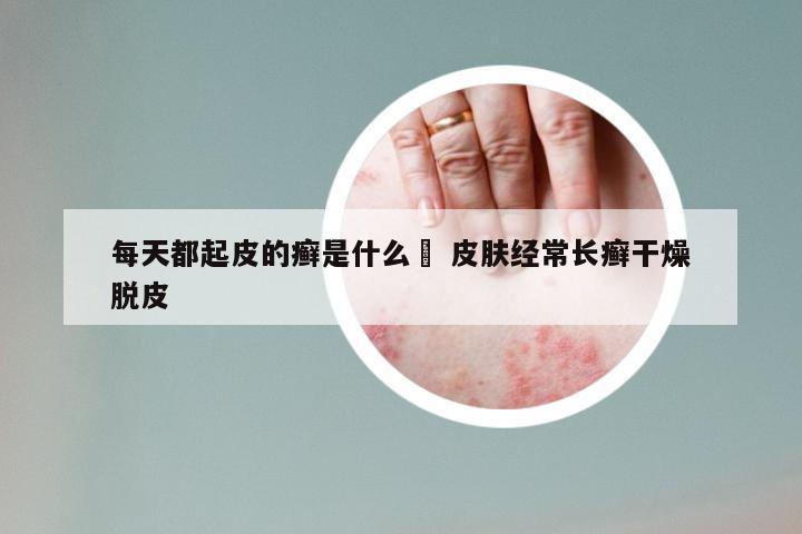 每天都起皮的癣是什么廯 皮肤经常长癣干燥脱皮
