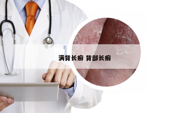 满背长癣 背部长癣