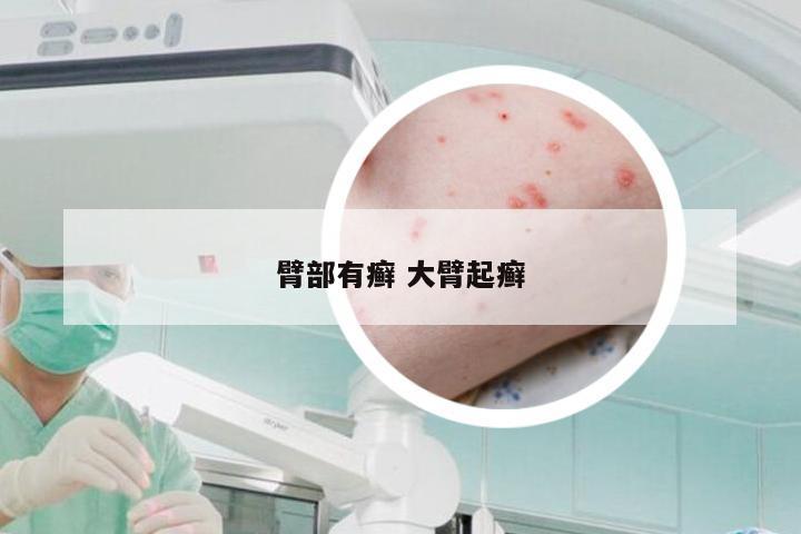 臂部有癣 大臂起癣