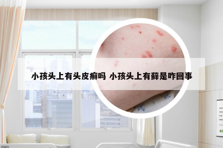 小孩头上有头皮癣吗 小孩头上有藓是咋回事
