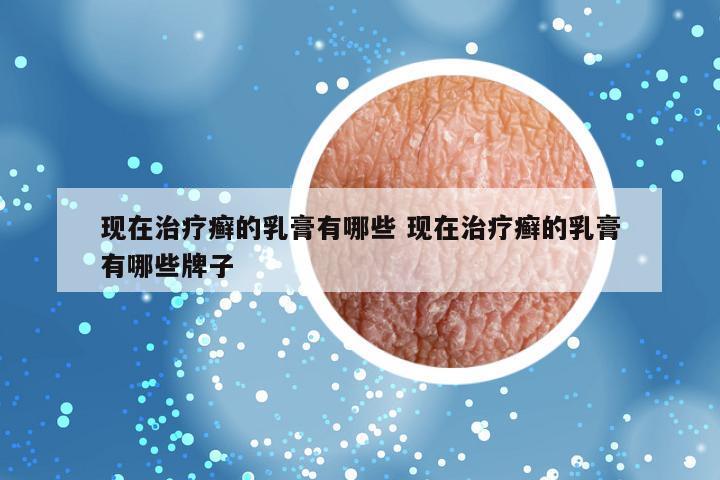 现在治疗癣的乳膏有哪些 现在治疗癣的乳膏有哪些牌子