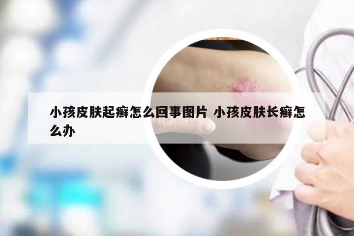 小孩皮肤起癣怎么回事图片 小孩皮肤长癣怎么办