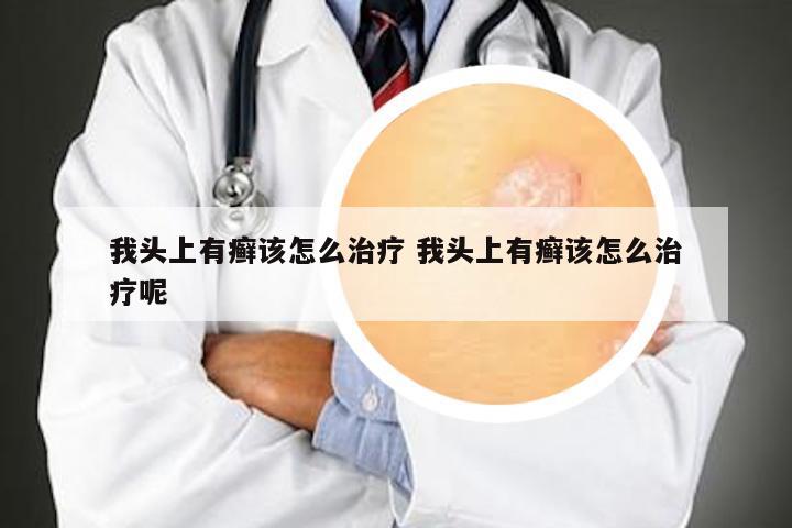 我头上有癣该怎么治疗 我头上有癣该怎么治疗呢