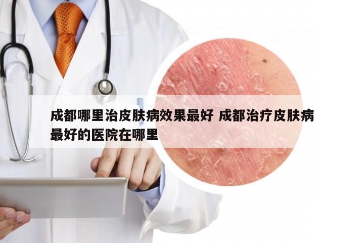 成都哪里治皮肤病效果最好 成都治疗皮肤病最好的医院在哪里