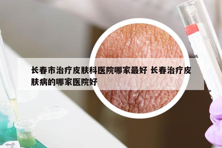 长春市治疗皮肤科医院哪家最好 长春治疗皮肤病的哪家医院好