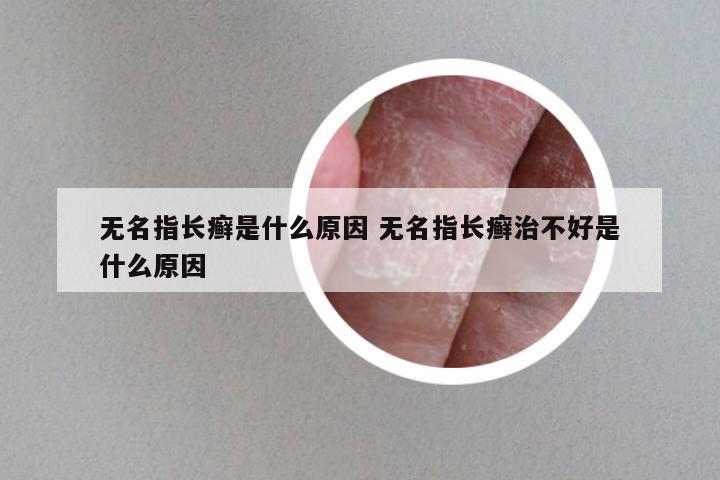 无名指长癣是什么原因 无名指长癣治不好是什么原因