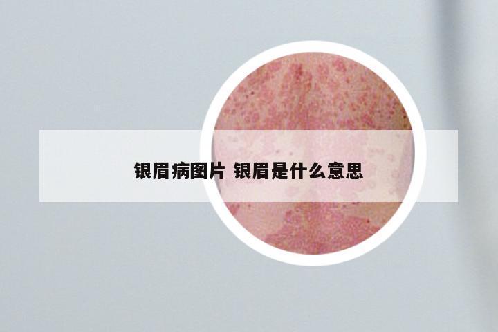 银眉病图片 银眉是什么意思