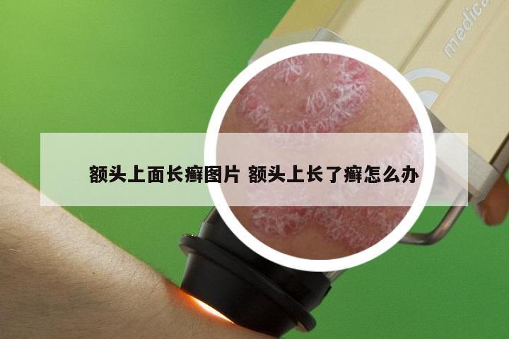 额头上面长癣图片 额头上长了癣怎么办