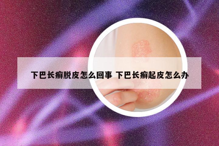 下巴长癣脱皮怎么回事 下巴长癣起皮怎么办