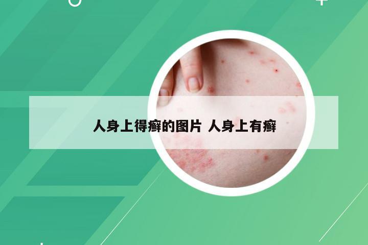 人身上得癣的图片 人身上有癣