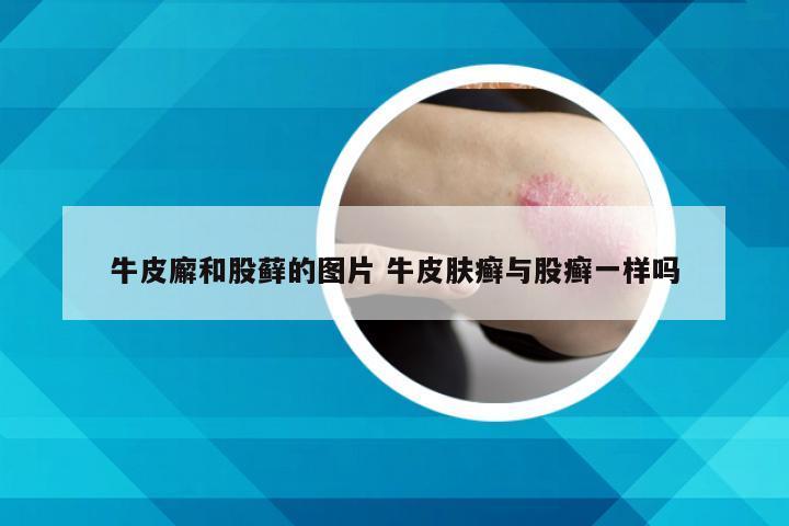 牛皮廨和股藓的图片 牛皮肤癣与股癣一样吗