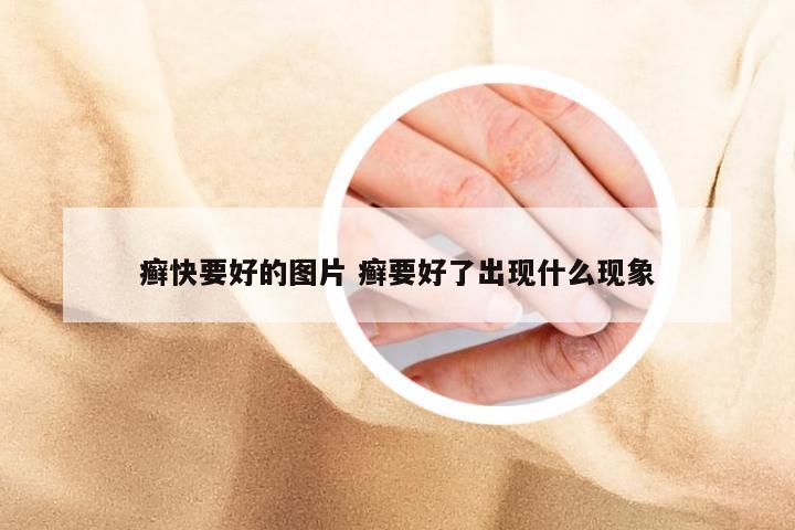 癣快要好的图片 癣要好了出现什么现象