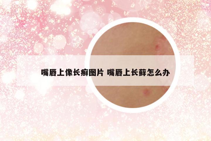 嘴唇上像长癣图片 嘴唇上长藓怎么办