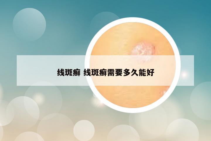 线斑癣 线斑癣需要多久能好