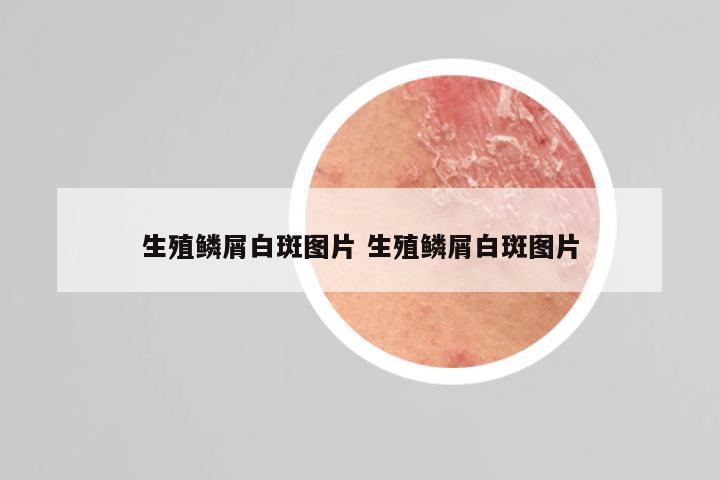 生殖鳞屑白斑图片 生殖鳞屑白斑图片
