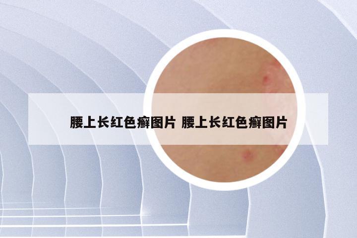 腰上长红色癣图片 腰上长红色癣图片