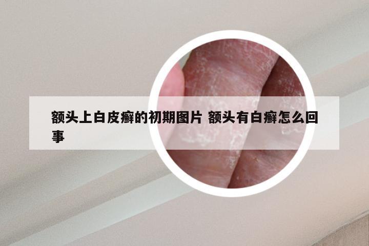 额头上白皮癣的初期图片 额头有白癣怎么回事