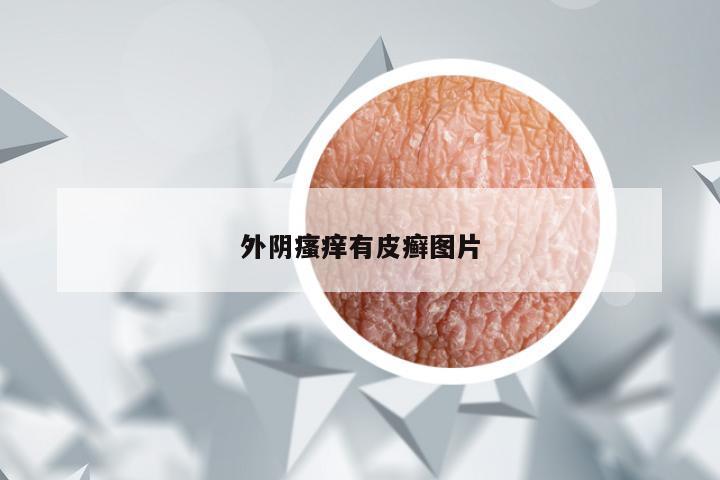 外阴瘙痒有皮癣图片