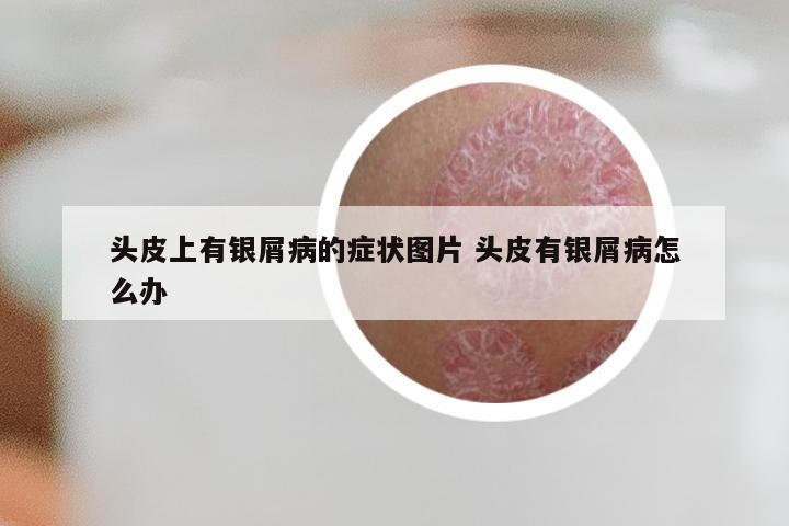 头皮上有银屑病的症状图片 头皮有银屑病怎么办