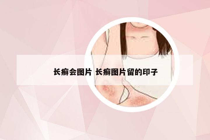 长癣会图片 长癣图片留的印子
