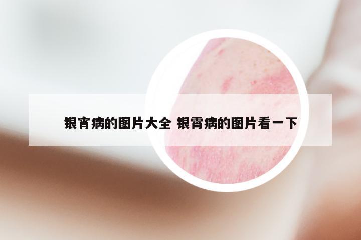 银宵病的图片大全 银霄病的图片看一下