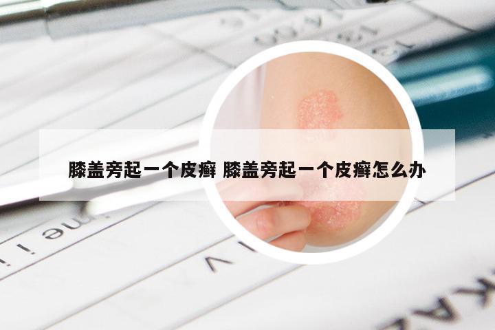 膝盖旁起一个皮癣 膝盖旁起一个皮癣怎么办