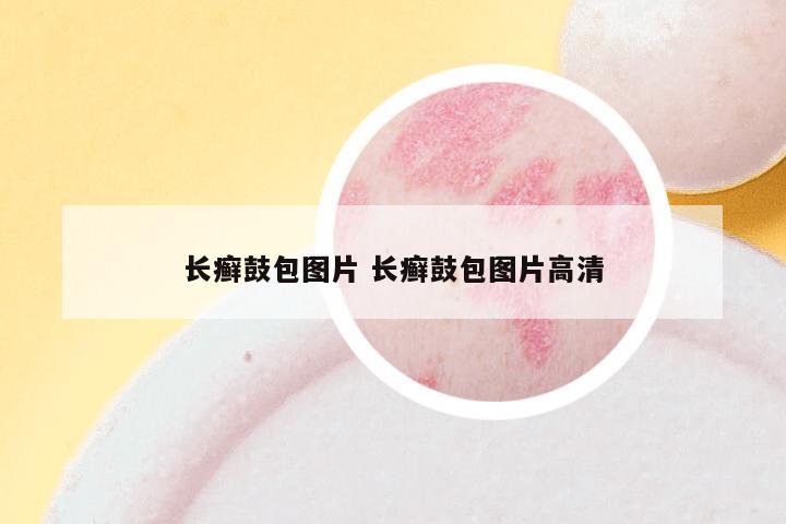 长癣鼓包图片 长癣鼓包图片高清