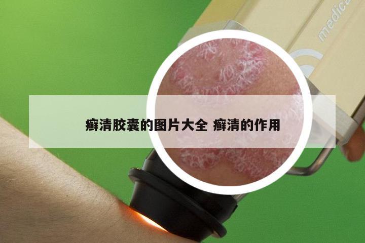 癣清胶囊的图片大全 癣清的作用