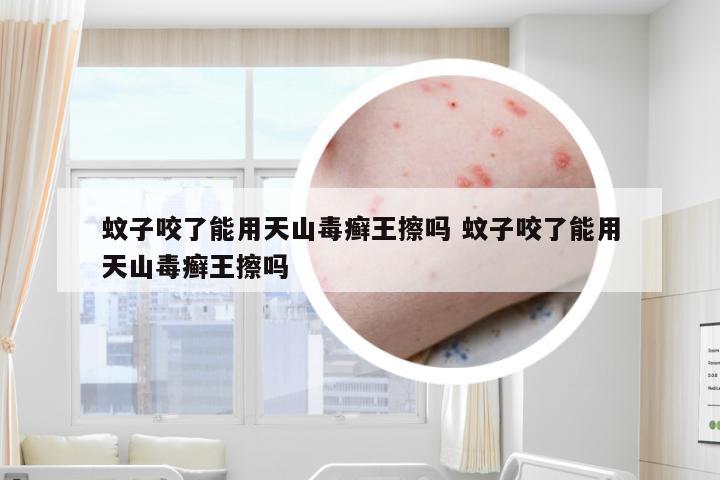 蚊子咬了能用天山毒癣王擦吗 蚊子咬了能用天山毒癣王擦吗