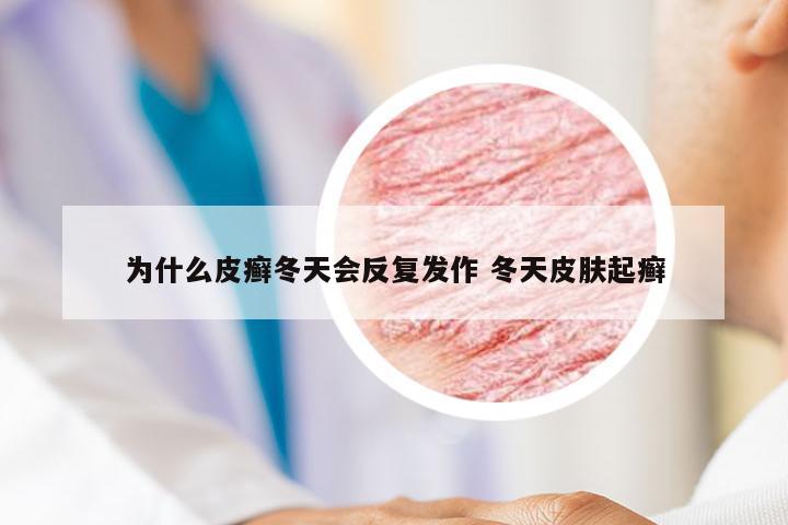 为什么皮癣冬天会反复发作 冬天皮肤起癣