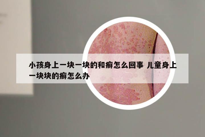 小孩身上一块一块的和癣怎么回事 儿童身上一块块的癣怎么办