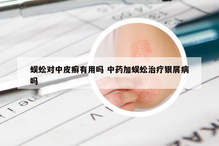 蜈蚣对中皮癣有用吗 中药加蜈蚣治疗银屑病吗