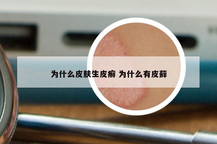 为什么皮肤生皮癣 为什么有皮藓