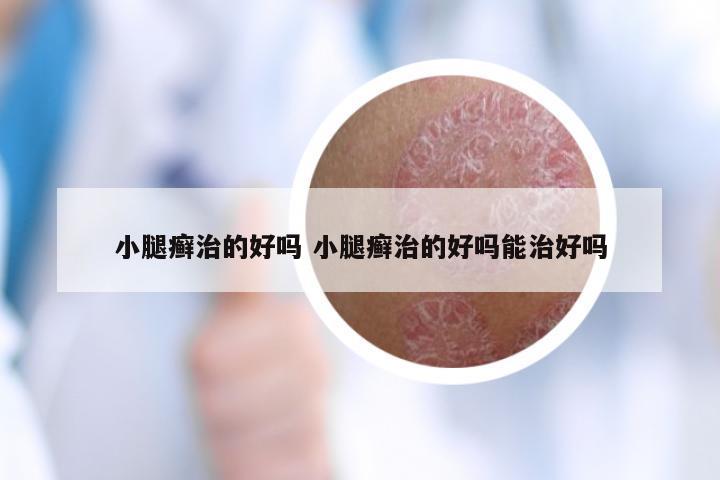 小腿癣治的好吗 小腿癣治的好吗能治好吗