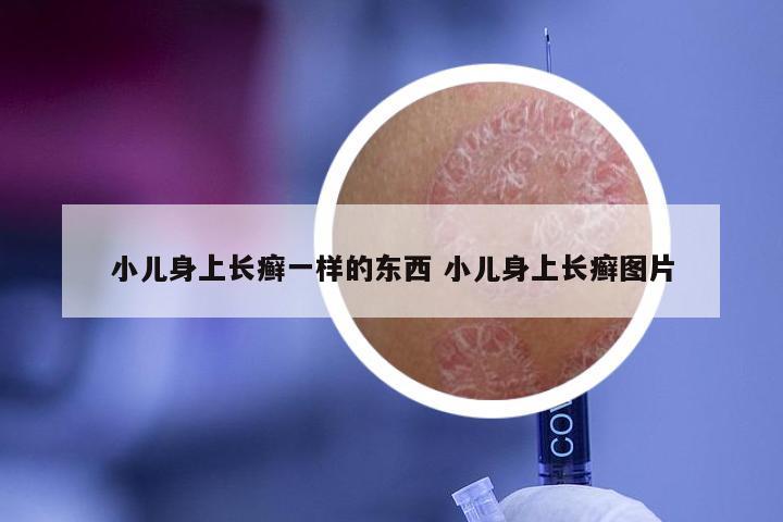 小儿身上长癣一样的东西 小儿身上长癣图片