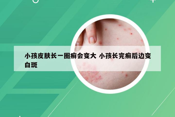 小孩皮肤长一圈癣会变大 小孩长完癣后边变白斑