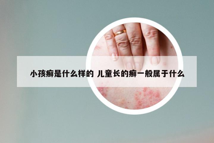 小孩癣是什么样的 儿童长的癣一般属于什么