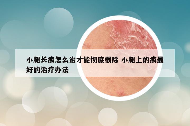 小腿长癣怎么治才能彻底根除 小腿上的癣最好的治疗办法
