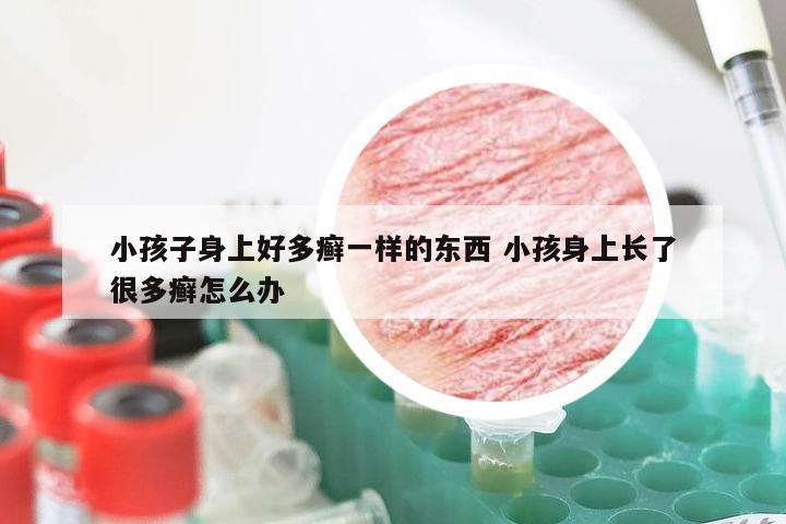 小孩子身上好多癣一样的东西 小孩身上长了很多癣怎么办
