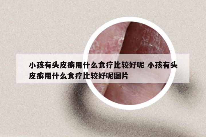 小孩有头皮癣用什么食疗比较好呢 小孩有头皮癣用什么食疗比较好呢图片