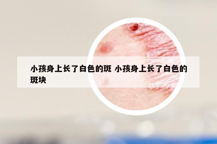 小孩身上长了白色的斑 小孩身上长了白色的斑块
