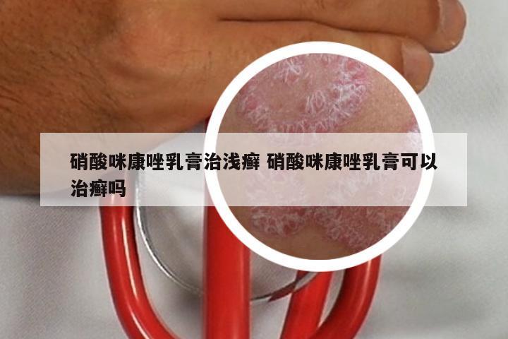 硝酸咪康唑乳膏治浅癣 硝酸咪康唑乳膏可以治癣吗