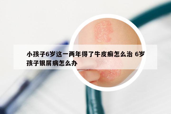 小孩子6岁这一两年得了牛皮癣怎么治 6岁孩子银屑病怎么办